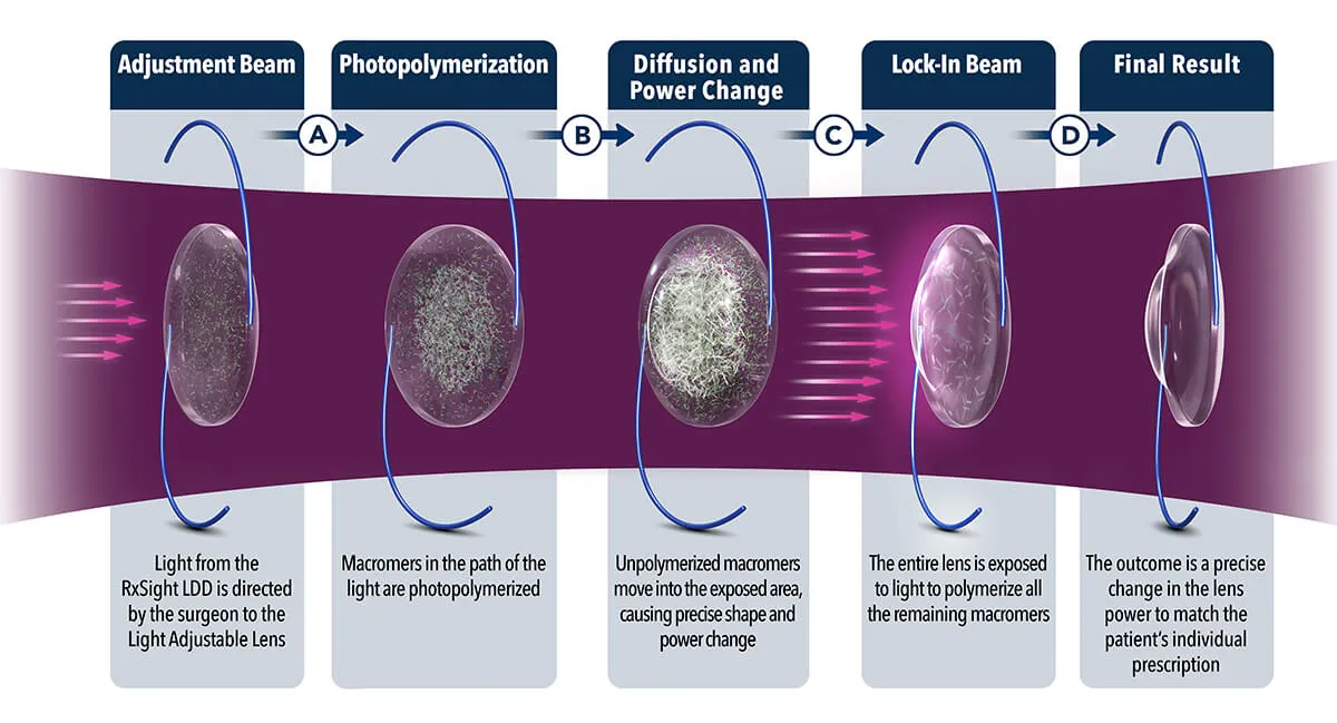 Light Adjustable Lens (LAL) in San Antonio San Antonio Eye Specialists